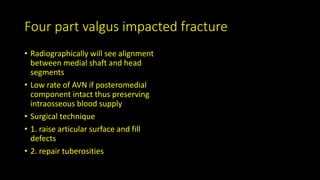 Four part valgus impacted fracture
• Radiographically will see alignment
between medial shaft and head
segments
• Low rate of AVN if posteromedial
component intact thus preserving
intraosseous blood supply
• Surgical technique
• 1. raise articular surface and fill
defects
• 2. repair tuberosities
 