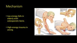 Mechanism
• low-energy falls in
elderly with
osteoporotic bone.
• High-energy trauma in
young.
 