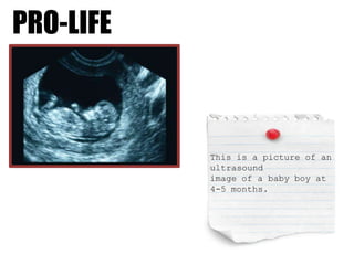 PRO-LIFE This is a picture of an ultrasound  image of a baby boy at 4-5 months. 