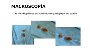 MACROSCOPÍA
●
Se toma biopsia y se envía al servicio de patología para su estudio.
 