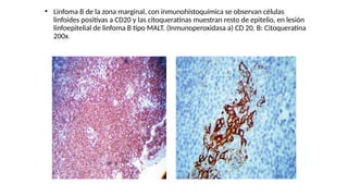 ●
Linfoma B de la zona marginal, con inmunohistoquímica se observan células
linfoides positivas a CD20 y las citoqueratinas muestran resto de epitelio, en lesión
linfoepitelial de linfoma B tipo MALT. (Inmunoperoxidasa a) CD 20. B: Citoqueratina
200x.
 