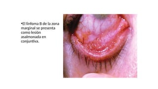 •El linfoma B de la zona
marginal se presenta
como lesión
asalmonada en
conjuntiva.
 