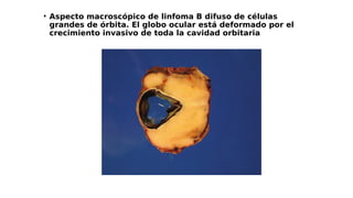 ●
Aspecto macroscópico de linfoma B difuso de células
grandes de órbita. El globo ocular está deformado por el
crecimiento invasivo de toda la cavidad orbitaria
 
