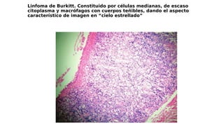 Linfoma de Burkitt. Constituido por células medianas, de escaso
citoplasma y macrófagos con cuerpos teñibles, dando el aspecto
característico de imagen en “cielo estrellado”
 