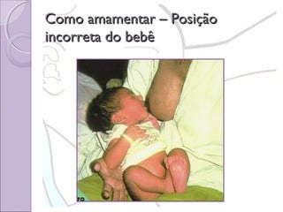 Como amamentar – Posição
incorreta do bebê

 