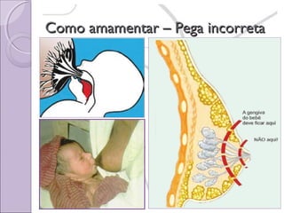 Como amamentar – Pega incorreta

 