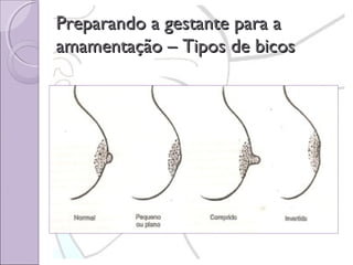 Preparando a gestante para a
amamentação – Tipos de bicos

 