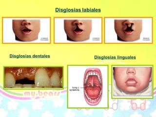 Disglosias labiales Disglosias dentales Disglosias linguales 