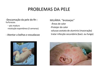PROBLEMAS DA PELE
-Descamação da pele do Rn :
furfuracea.
- pós maduro
-resolução espontânea (2 semanas)
- Atentar a bolhas e exsudacao
MILIÁRIA: ‘’brotoejas’’
-Áreas de calor
-Protejer do calor
solucao acetato de aluminio (maceração)
tratar infecção secundária (bact. ou fungo)
 