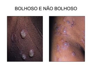 BOLHOSO E NÃO BOLHOSO
 