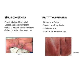 SÍFILIS CONGÊNITA IRRITATIVA PRIMÁRIA
-Deixar sem fralda
-Trocar com frequência
-Sabão Neutro
-Acetato de alumínio 1:30
Eritema
-Principal diag diferencial!
-Lesoes que nao melhoram
-Mácula, papula, bolha + erosões
-Palma da mão, planta dos pes
 