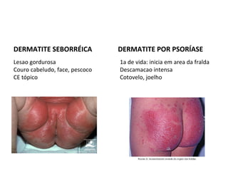 DERMATITE SEBORRÉICA DERMATITE POR PSORÍASE
Lesao gordurosa
Couro cabeludo, face, pescoco
CE tópico
1a de vida: inicia em area da fralda
Descamacao intensa
Cotovelo, joelho
 