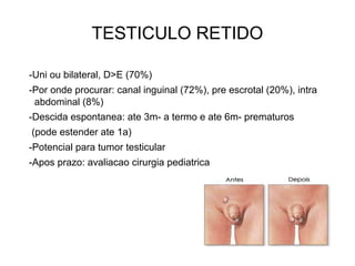 TESTICULO RETIDO
-Uni ou bilateral, D>E (70%)
-Por onde procurar: canal inguinal (72%), pre escrotal (20%), intra
abdominal (8%)
-Descida espontanea: ate 3m- a termo e ate 6m- prematuros
(pode estender ate 1a)
-Potencial para tumor testicular
-Apos prazo: avaliacao cirurgia pediatrica
 