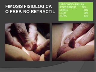 FIMOSIS FISIOLOGICA
O PREP. NO RETRACTIL
ES FISIOLOGICA EN EL RN
RECIEN NACIDOS 96%
6 MESES 80%
1 AÑO 50%
3 AÑOS 10%
 