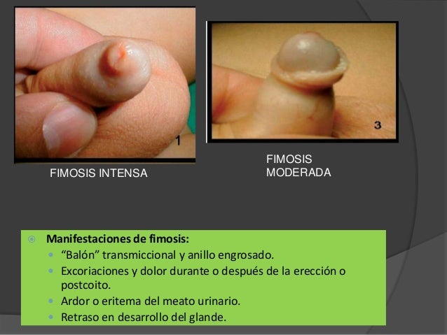 Las revocaciones sobre un pequeño miembro