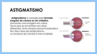 ASTIGMATISMO
Astigmatismo é causado pelo formato
irregular da córnea ou do cristalino,
formando uma imagem em vários
focos que se encontram em eixos
diferentes. Uma córnea normal é redonda e
lisa. Nos casos de astigmatismo,
a curvatura da córnea é mais ovalada.
 
