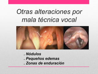 Otras alteraciones por
mala técnica vocal
. Nódulos
. Pequeños edemas
. Zonas de enduración
 