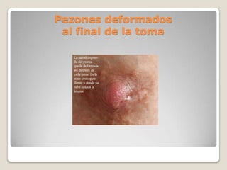 Pezones deformados
al final de la toma
 
