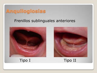 Anquiloglosias
Frenillos sublinguales anteriores
Tipo I Tipo II
 