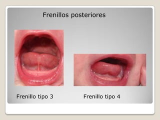 Frenillos posteriores
Frenillo tipo 3 Frenillo tipo 4
 