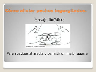 Cómo aliviar pechos ingurgitados:
Masaje linfático
Para suavizar al areola y permitir un mejor agarre.
 