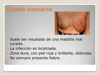 Abceso mamario
 Suele ser resultado de una mastitis mal
curada.
 La infección es localizada.
 Zona dura, con piel roja y brillante, dolorosa.
 No siempre presenta fiebre.
 