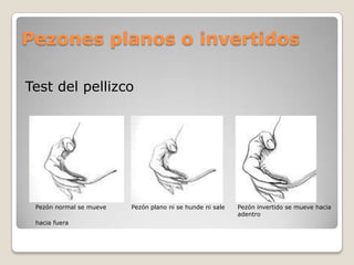 Pezones planos o invertidos
Test del pellizco
Pezón normal se mueve Pezón plano ni se hunde ni sale Pezón invertido se mueve hacia
adentro
hacia fuera
 