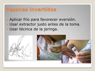 Pezones invertidos
 Aplicar frío para favorecer eversión.
 Usar extractor justo antes de la toma.
 Usar técnica de la jeringa.
 