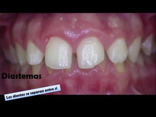 Diastemas
 
