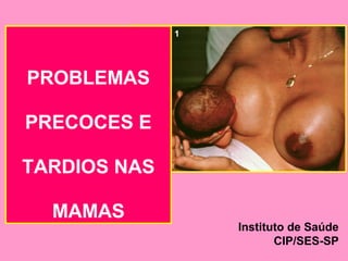 1




PROBLEMAS

PRECOCES E

TARDIOS NAS

  MAMAS
                  Instituto de Saúde
                         CIP/SES-SP
 