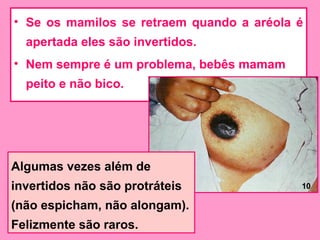 • Se os mamilos se retraem quando a aréola é
  apertada eles são invertidos.
• Nem sempre é um problema, bebês mamam
  peito e não bico.




Algumas vezes além de
invertidos não são protráteis              10

(não espicham, não alongam).
Felizmente são raros.
 