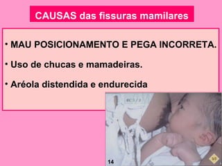 CAUSAS das fissuras mamilares

• MAU POSICIONAMENTO E PEGA INCORRETA.

• Uso de chucas e mamadeiras.

• Aréola distendida e endurecida




                       14
 