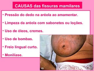 CAUSAS das fissuras mamilares

• Pressão do dedo na aréola ao amamentar.

• Limpeza da aréola com sabonetes ou loções.

• Uso de óleos, cremes.

• Uso de bombas.

• Freio lingual curto.

• Monilíase.


                         15
 