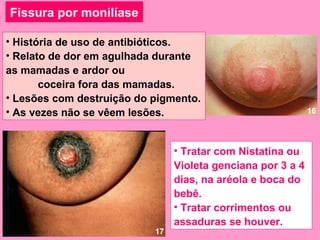 Fissura por monilíase

• História de uso de antibióticos.
• Relato de dor em agulhada durante
as mamadas e ardor ou
       coceira fora das mamadas.
• Lesões com destruição do pigmento.
• As vezes não se vêem lesões.                               16




                                • Tratar com Nistatina ou
                                Violeta genciana por 3 a 4
                                dias, na aréola e boca do
                                bebê.
                                • Tratar corrimentos ou
                                assaduras se houver.
                           17
 