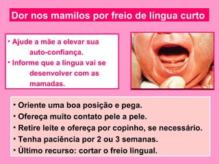 Dor nos mamilos por freio de língua curto

• Ajude a mãe a elevar sua
       auto-confiança.
• Informe que a língua vai se
       desenvolver com as
       mamadas.                                         18


 • Oriente uma boa posição e pega.
 • Ofereça muito contato pele a pele.
 • Retire leite e ofereça por copinho, se necessário.
 • Tenha paciência por 2 ou 3 semanas.
 • Último recurso: cortar o freio lingual.
 
