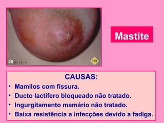 Mastite

20


                     CAUSAS:
•    Mamilos com fissura.
•    Ducto lactífero bloqueado não tratado.
•    Ingurgitamento mamário não tratado.
•    Baixa resistência a infecções devido a fadiga.
 