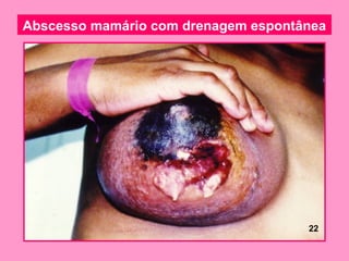 Abscesso mamário com drenagem espontânea




                                     22
 