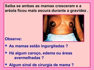 Saiba se ambas as mamas cresceram e a
aréola ficou mais escura durante a gravidez .




Observe:                                 4

   As mamas estão ingurgitadas ?
   Há algum caroço, edema ou áreas
      avermelhadas ?
   Algum sinal de cirurgia de mama ?
 
