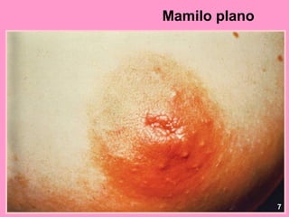 Mamilo plano




               7
 