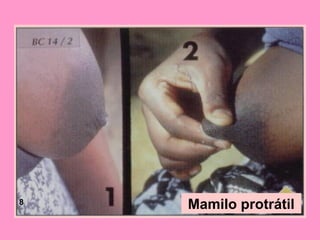 8
    Mamilo protrátil
 