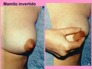 Mamilo invertido




                   9
 