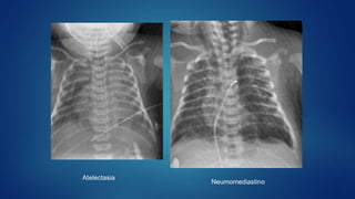 Atelectasia
Neumomediastino
 