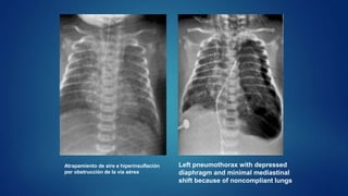 Atrapamiento de aire e hiperinsuflación
por obstrucción de la via aérea
Left pneumothorax with depressed
diaphragm and minimal mediastinal
shift because of noncompliant lungs
 