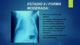 ESTADIO II / FORMA
MODERADA:
• Esta es la forma más
clásica.
• La imagen reticulogranular
se extiende a través de
todo el campo pulmonar.
• El broncograma aéreo es
muy visible, y sobrepasa
los límites de la silueta
cardiaca.
• La transparencia pulmonar
esta disminuida.
 