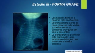 Estadio III / FORMA GRAVE:
• Los nódulos tienden a
hacerse más confluentes.
• El broncograma aéreo se
hace cada vez más visible,
y pueden verse ya
ocupados bronquios del
2do. y 3er. orden.
• La transparencia pulmonar
esta disminuida; pero
todavía se distinguen los
límites de la silueta
cardiaca.
 