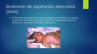 Síndrome de aspiración Meconial
(SAM)
 El síndrome de aspiración meconial (SAM) se manifiesta con distrés
respiratorio y es producido por la aspiración de líquido amniótico
teñido con meconio intra útero o intra parto.
 