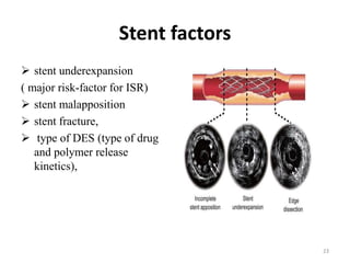 Stent factors
 stent underexpansion
( major risk-factor for ISR)
 stent malapposition
 stent fracture,
 type of DES (type of drug
and polymer release
kinetics),
23
 