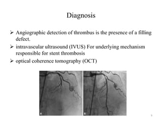 Diagnosis
 Angiographic detection of thrombus is the presence of a filling
defect.
 intravascular ultrasound (IVUS) For underlying mechanism
responsible for stent thrombosis
 optical coherence tomography (OCT)
9
 