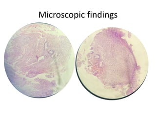 Microscopic findings
 