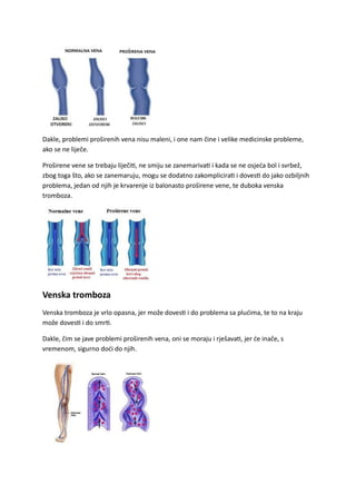 Dakle, problemi proširenih vena nisu maleni, i one nam čine i velike medicinske probleme,
ako se ne liječe.
Proširene vene se trebaju liječiti, ne smiju se zanemarivati i kada se ne osjeća bol i svrbež,
zbog toga što, ako se zanemaruju, mogu se dodatno zakomplicirati i dovesti do jako ozbiljnih
problema, jedan od njih je krvarenje iz balonasto proširene vene, te duboka venska
tromboza.
Venska tromboza
Venska tromboza je vrlo opasna, jer može dovesti i do problema sa plućima, te to na kraju
može dovesti i do smrti.
Dakle, čim se jave problemi proširenih vena, oni se moraju i rješavati, jer će inače, s
vremenom, sigurno doći do njih.
 